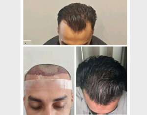 hair-transplant