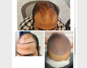 hair-transplant2
