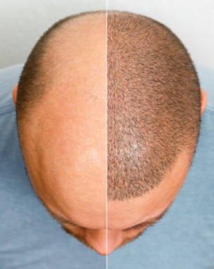 Hair restoration before and after