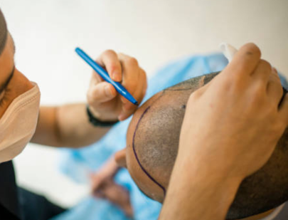 Surgeon marking scalp before a hair transplant